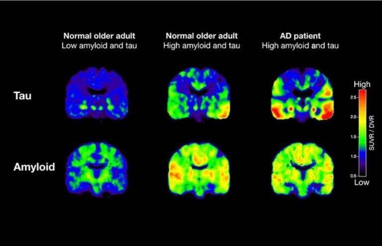 Pompano Beach Alzheimer’s Patient Sees Brain Plaques Cleared After 18 Months of Treatment